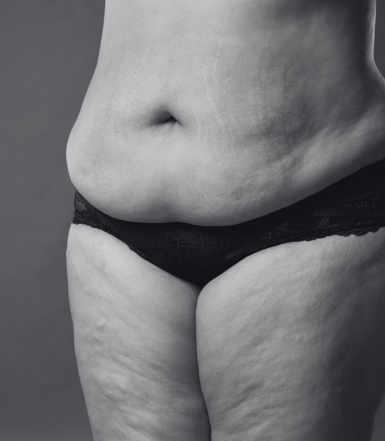 Image comparing mild and severe cellulite grades Deal