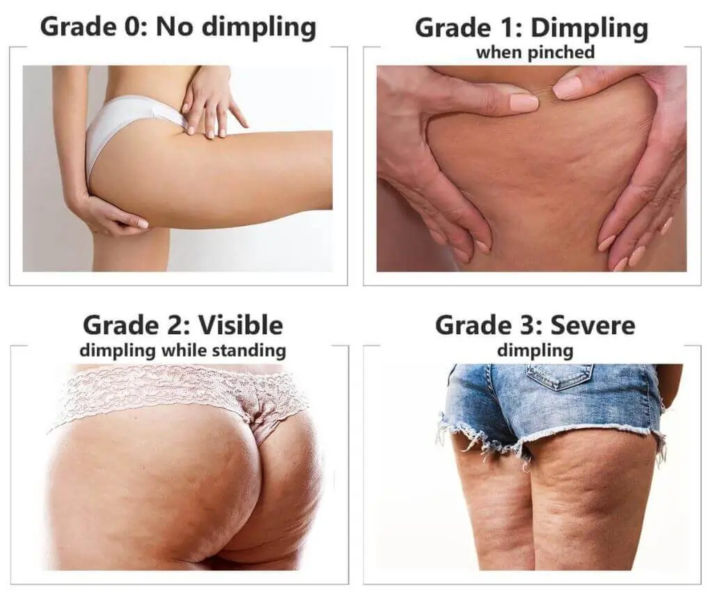 Representation of the stages of cellulite development Deal